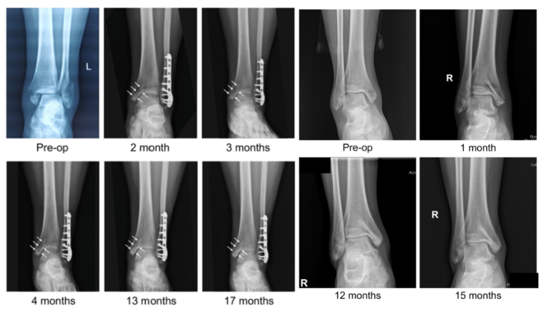 醫(yī)用鎂合金骨內(nèi)植物臨床試驗研究突破性進(jìn)展(圖2)