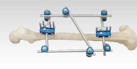 骨科外固定支架注冊技術審查指導原則(2018年修訂)(2018年第107號)(圖1) 骨科外固定支架注冊技術審查指導原則(2018年修訂)(2018年第107號)(圖1)