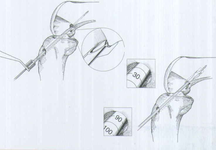 肌腱韌帶固定系統(tǒng)注冊技術(shù)審查指導(dǎo)原則（2020年第36號）